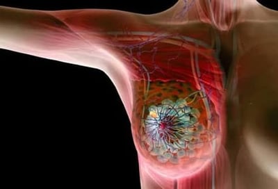 Breast Cancer Awareness Month Prompts Doctors to Share 5 Vital Health Tips for Working Women to Lower Disease Risk